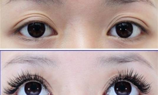 睫毛移植术