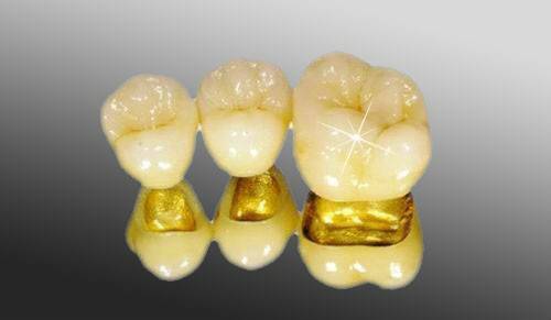 黄金烤瓷牙