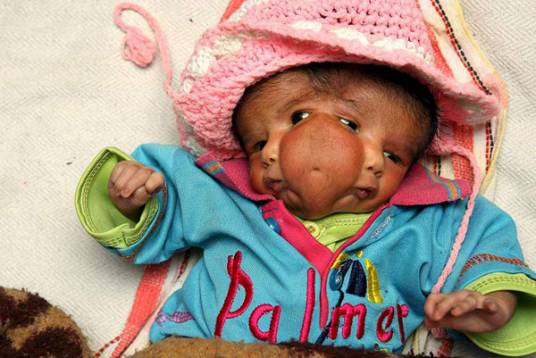 双面女婴（印度患病女婴）