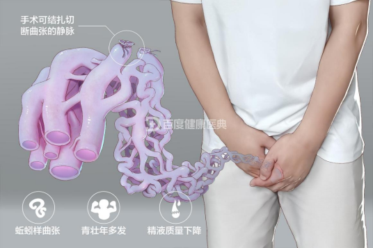 精索静脉曲张