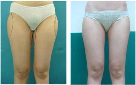 腿部吸脂手术