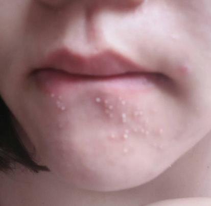 唇边痘