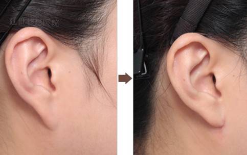 耳垂再造整形术
