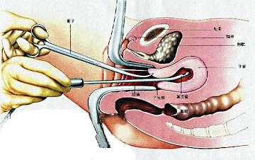双腔减压人流术
