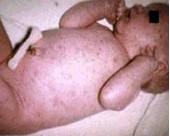 先天性风疹综合症