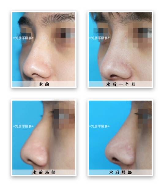 鼻头缩小术