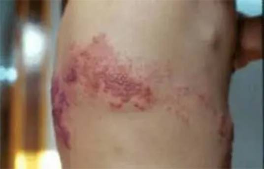 带状疱疹后遗症