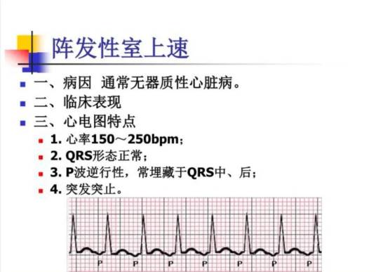 阵发性室上性心动过速