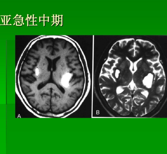 海绵状脑血管瘤