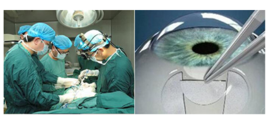 青光眼激光手术