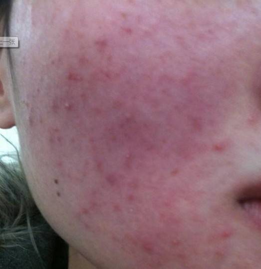 面部激素依赖性皮炎