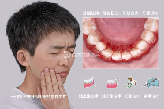 牙周炎（病名）