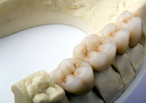 银钯合金烤瓷牙