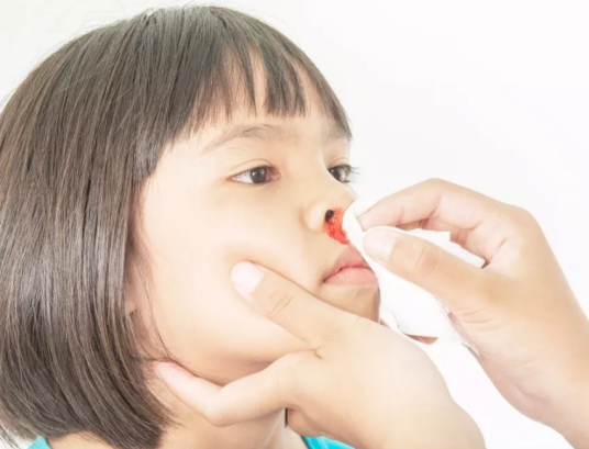 儿童鼻出血