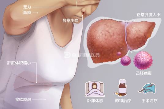 肝硬化（慢性进行性肝病）