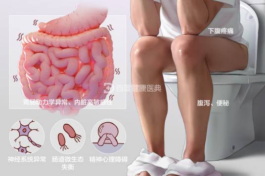 肠易激综合征（疾病名）