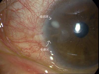 病毒性角膜炎（受病毒致病原感染角膜而引起的炎症）