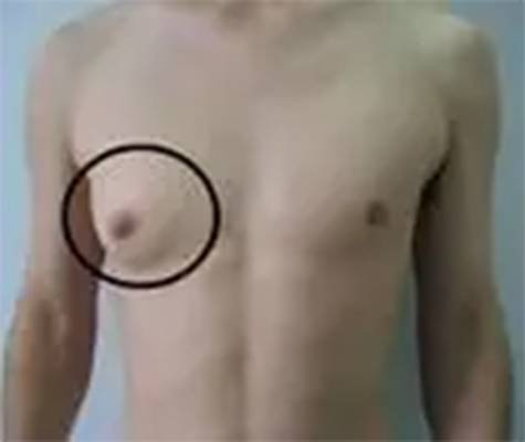 男性乳腺增生