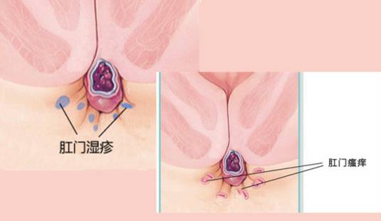 肛周瘙痒