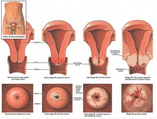 高危型人乳头瘤病毒