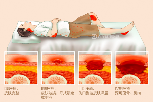 压疮