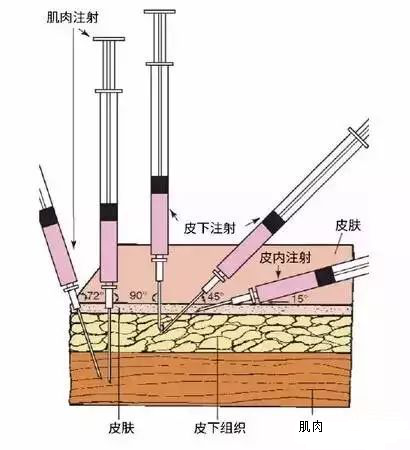 肌肉注射法