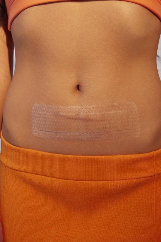 剖腹产疤痕