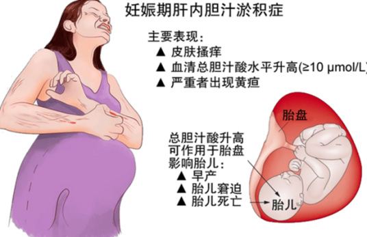 孕期胆汁淤积症