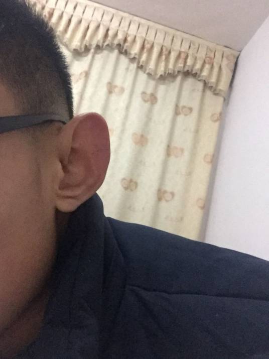 招风耳（先天性畸形病症）