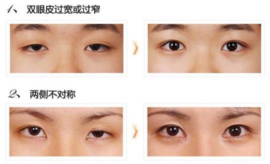 双眼皮修复术