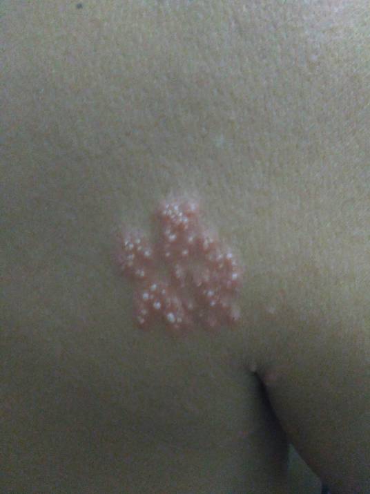 水痘-带状疱疹病毒