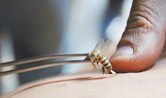 蜂疗（治疗方法）