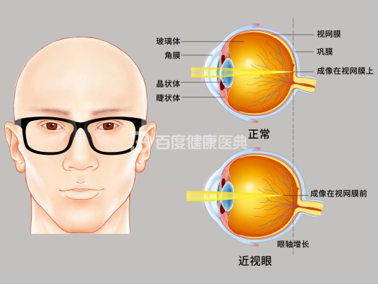 近视（疾病名）