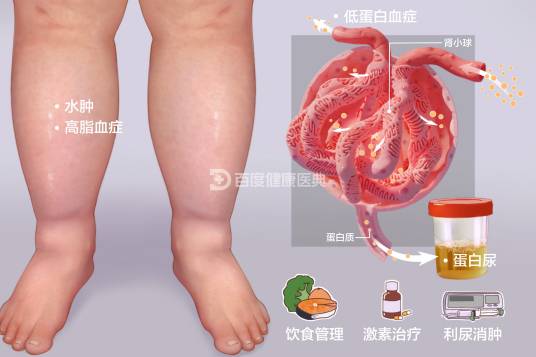 肾病综合征（疾病名称）