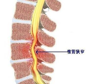 椎管狭窄