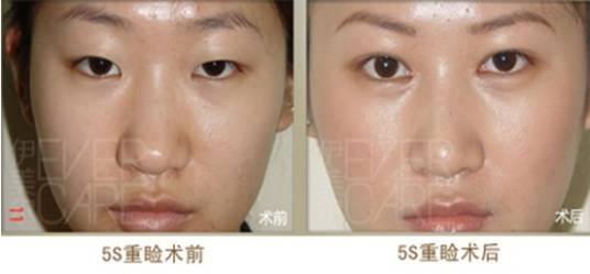 5S重睑术