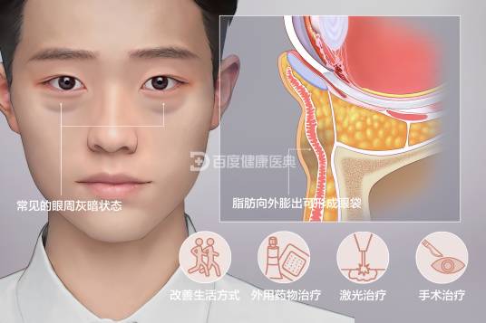 黑眼圈（生理现象）