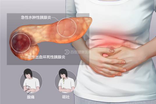 急性胰腺炎