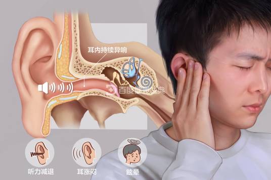 耳鸣（身体疾病）