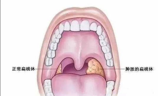 扁桃体肿大