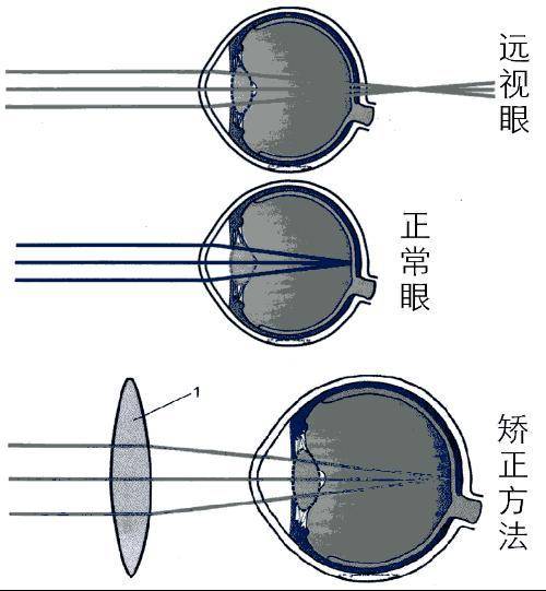 远视（眼科疾病）