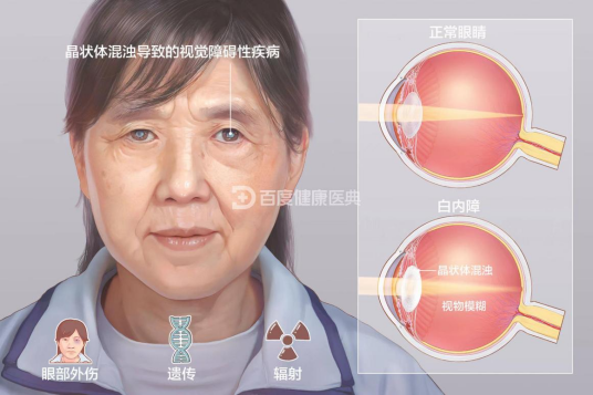 白内障（病症名）