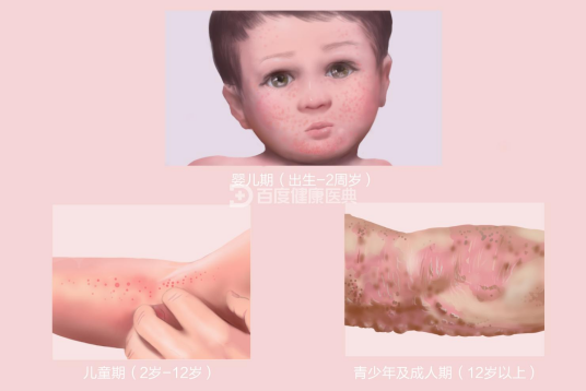 特应性皮炎（病症名称）