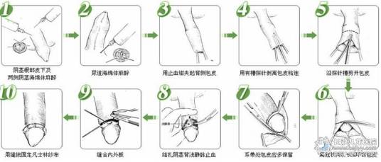 包皮过长手术