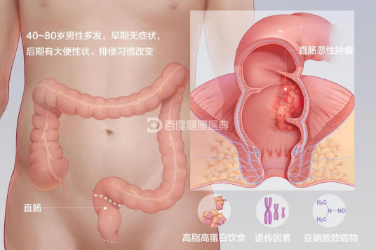 直肠癌（病症名称）