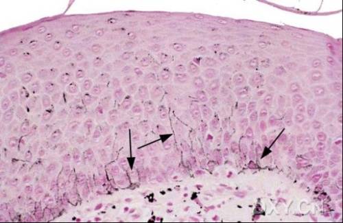朗格汉斯细胞增生症