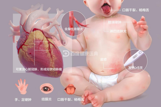 黏膜皮肤淋巴结综合征