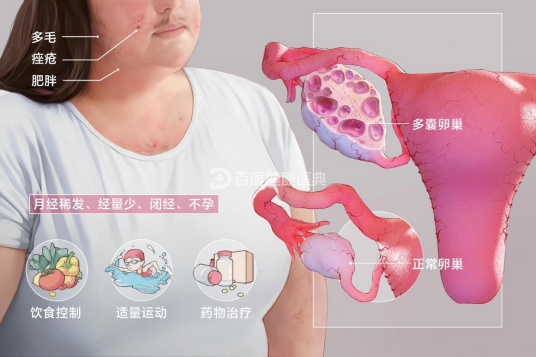 多囊卵巢综合征