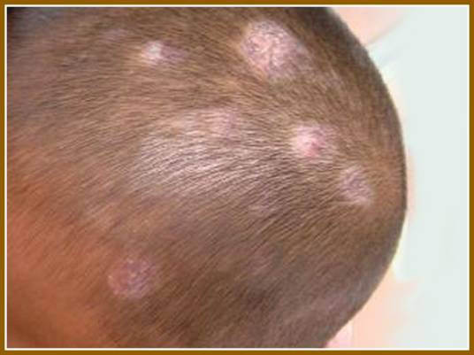 头部脂溢性皮炎