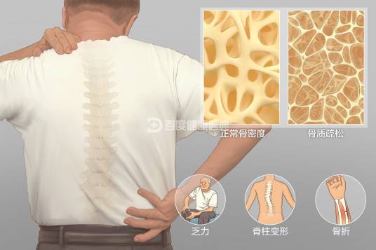 骨质疏松症（病症名）